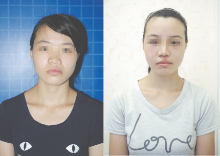 小清术前术后15天对比照